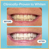 Teeth whitening before-and-after results showing brighter front teeth